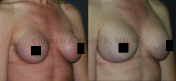 Breast Augmentation Revision for Capsular Contracture