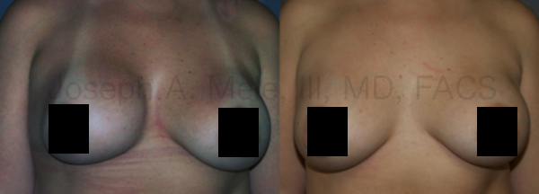Breast Augmentation Revision for Capsular Contracture Unilateral