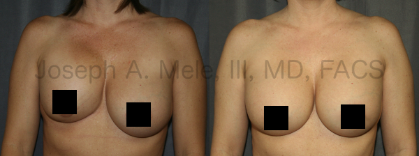 Breast Augmentation Revision for Capsular Contracture Unilateral