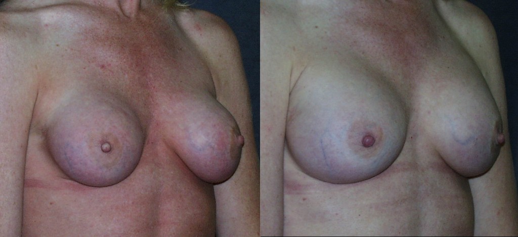 Capsular Contracture Before and After Capsulectomy