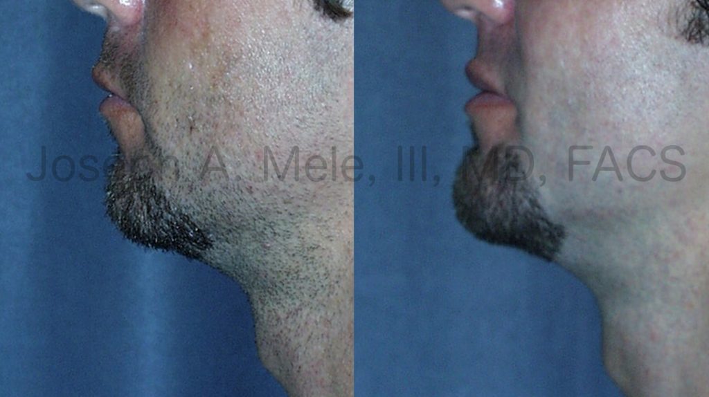 Comparing the Chin Augmentation before and after pictures of this man and the woman above, you can see that the ideal chin projection for men is larger with respect to the lower lip. Facial proportions do vary; however, in general men tend to have larger bony features than women. This is especially true of the chin and the nose.