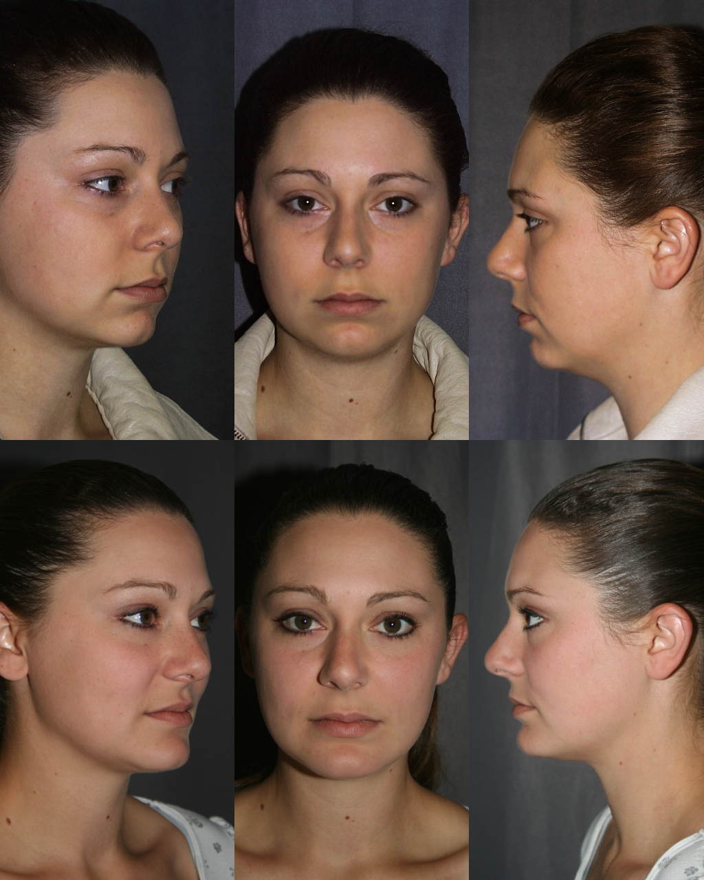 Chin Augmentation with Chin Implant. Before (Top Row) & After (Bottom Row)
