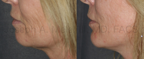 Chin Augmentation can be combined with neck and face lifts to correct a small chin and enhance the jawline.
