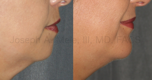 A strong female chin still looks feminine and helps to define the border between the face and neck.