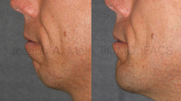 The Chin Augmentation before and after pictures above demonstrate the difference a strong jaw makes on the profile view. Chin Implants can provide balance to a disproportionately small jaw.