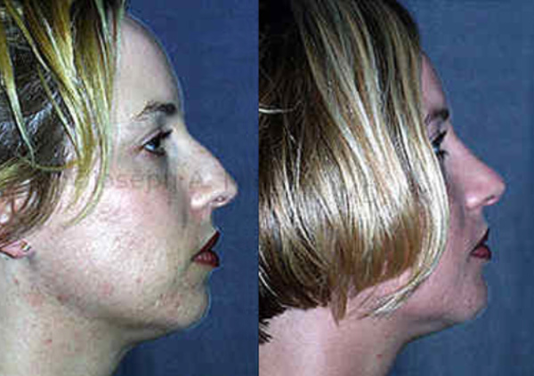 Chin Augmentation can provide proportion to the profile and balance a nose that is too large for the chin.