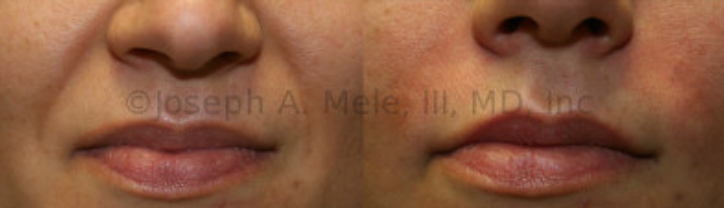 Dermal Filler to Treat Facial Wrinkles - Immediately after Perlane injections to Facial Wrinkles in the Naso-Labial folds with typical post-injection redness and swelling. The redness lasts about 24 hours, and can often be concealed with makeup.