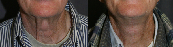 The platysma is a flat muscle that supports the neck skin.  Often it is separated in the midline. As we age, we see this separation as Platysmal Bands, the two cords running down the front of the neck. One goal of the Neck Lift is to diminish to appearance of these bands.