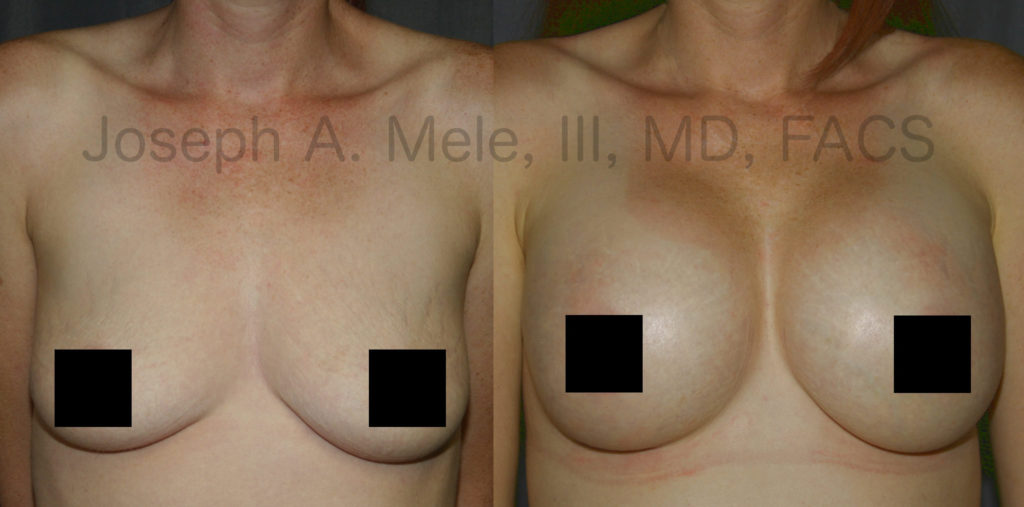 Breast Implants can put the stuffing back into deflated breasts.