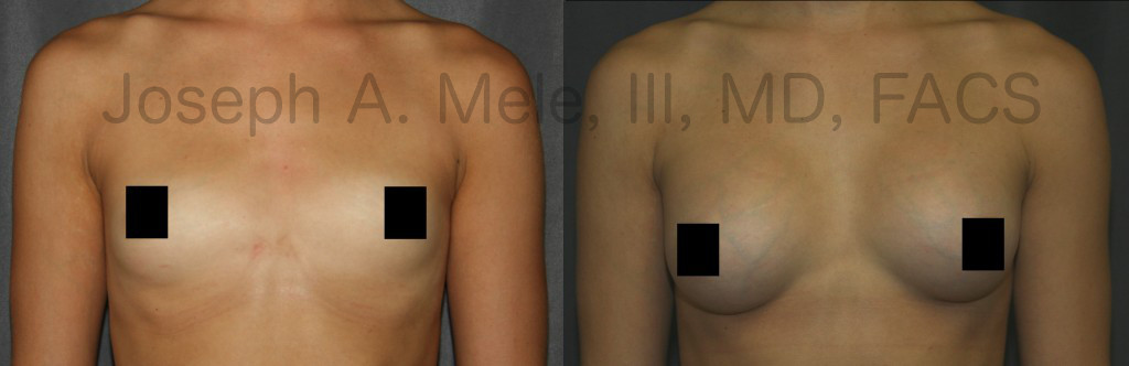 Choosing the right size for you is the most important aspect of Breast Augmentation.