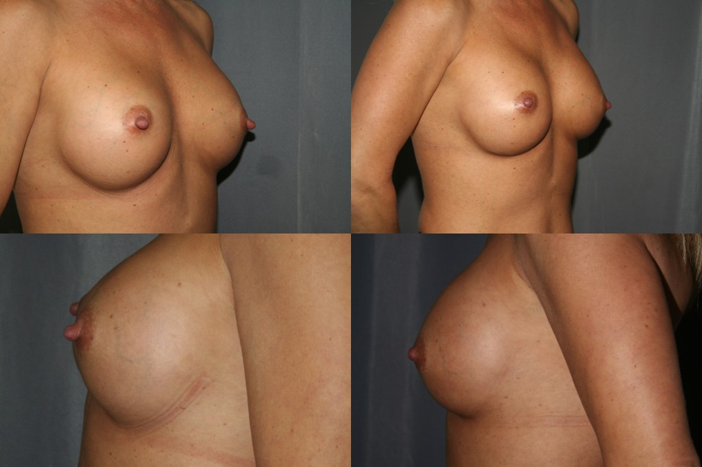 Breast Augmentation Revision with Nipple Reduction - Before (left) and After (right)