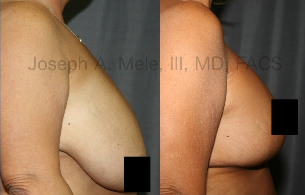 Breast Reduction relieves pain while improving physical appearance by restoring body proportions.
