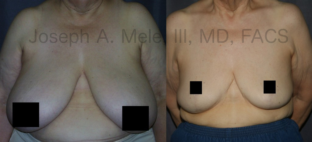 Breast Reduction improves the proportions of the breasts, relieves the symptoms that large heavy breasts cause, and makes shopping for clothing much easier.