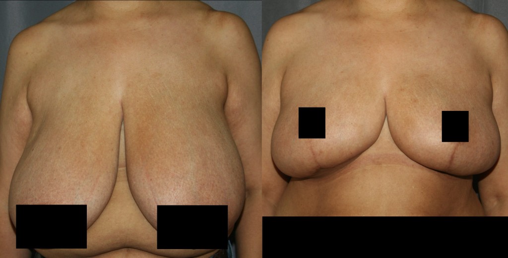 Breast Reduction for Women