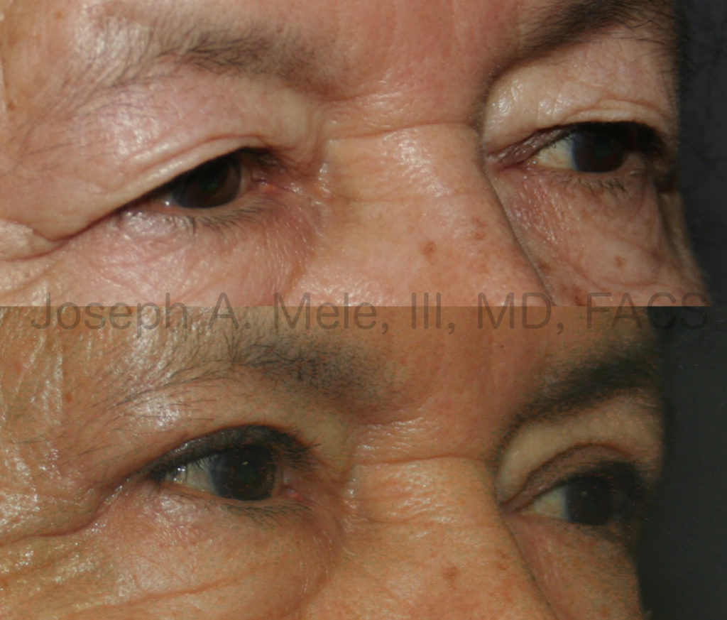 In the upper (before) shows severe hooding of the entire upper eyelid. After her blepharoplasty, her upper eyelids are now visible, and a smooth upper eyelid crease has been created.