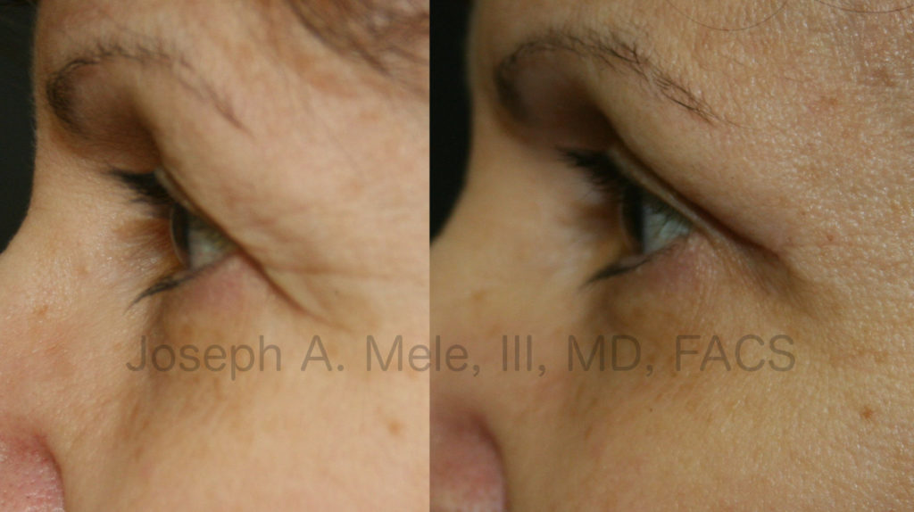 In these Blepharoplasty Before and After Pictures, the before picture on the left shows the lateral brow skin completely covering the outer eyelid. In the after picture on the right, the brow skin is elevated, giving a much cleaner, refreshed and younger look.