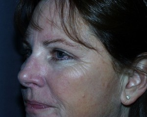 After blepharoplasty the skin of the upper eyelid can now be seen above the lashes.