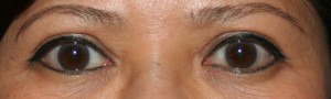 One year after upper blepharoplasty the fold above the eye remains smooth and discrete.