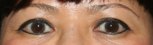 Before upper blepharoplasty the upper eyelid skin is resting on the eyelashes.