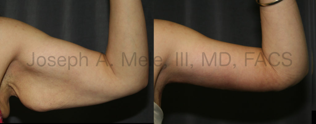 Arm lifts allow for the reduction and tightening of the upper arm, and restore the normal arm proportions after weight loss.