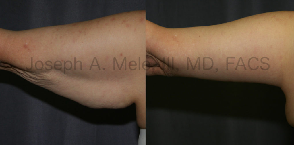 Brachioplasty removes excess skin and fat creating a tighter, smaller upper arm.