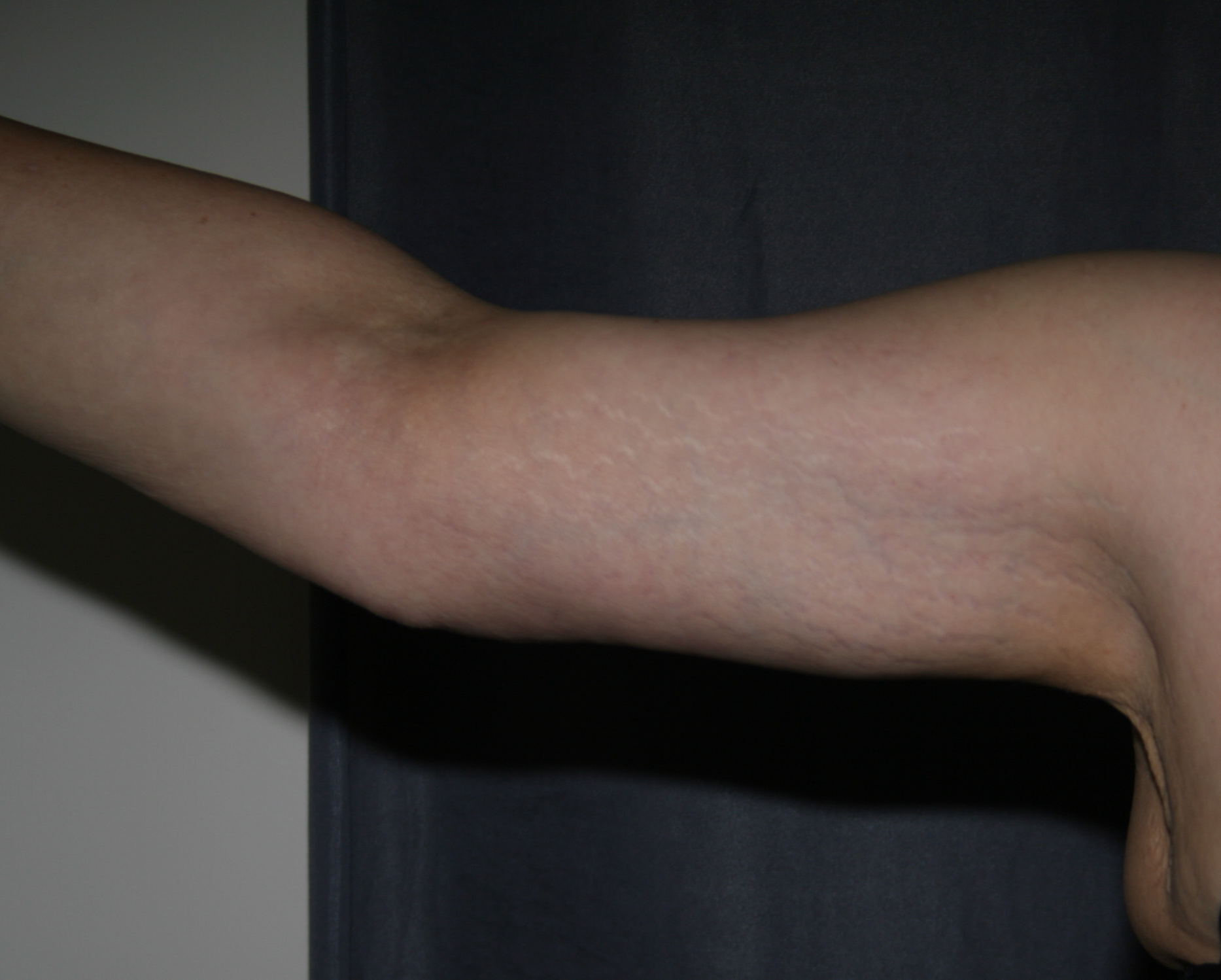 Right Arm after weight loss and after Arm Lift (Brachioplasty)