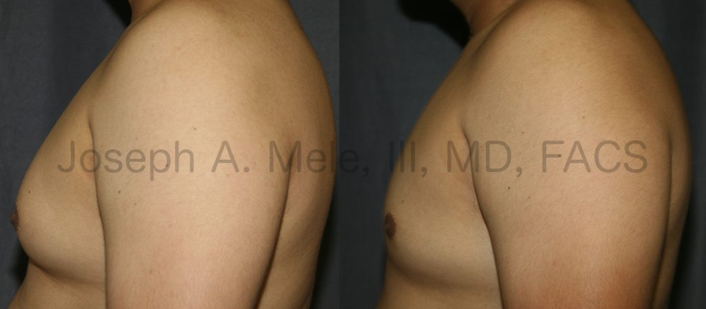 When Gynecomastia is distributed throughout the chest, more must be done. In this case, Liposuction was used to remove the bulk of the disproportionate chest tissue. If a glandular component is present beneath the nipple, this tissue also needs to be removed.