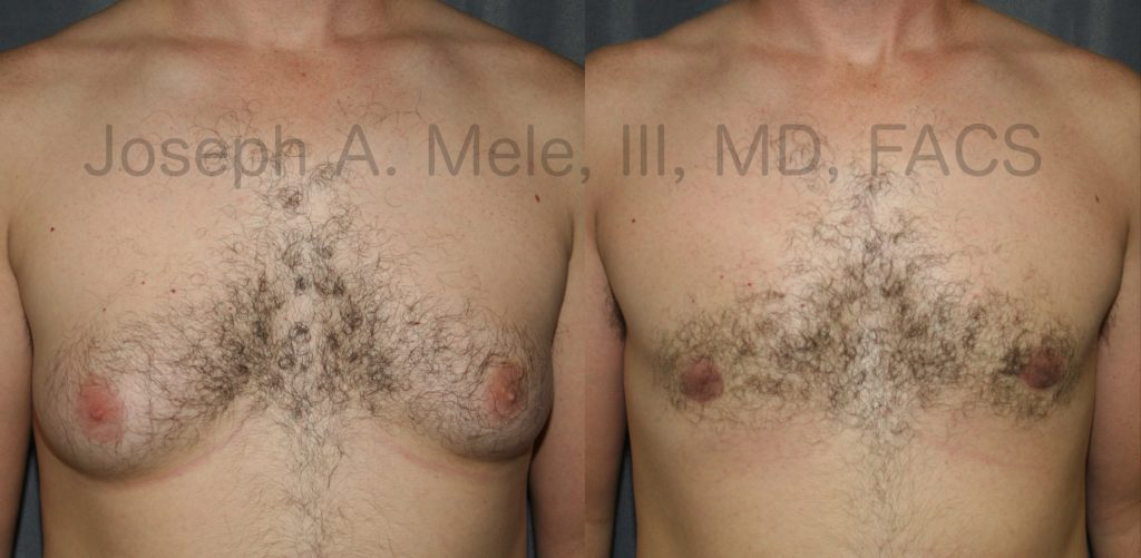 The above Gynecomastia reduction surgery before and after photos show what is possible with a combination of liposuction and direct excision for an enlarged male chest.