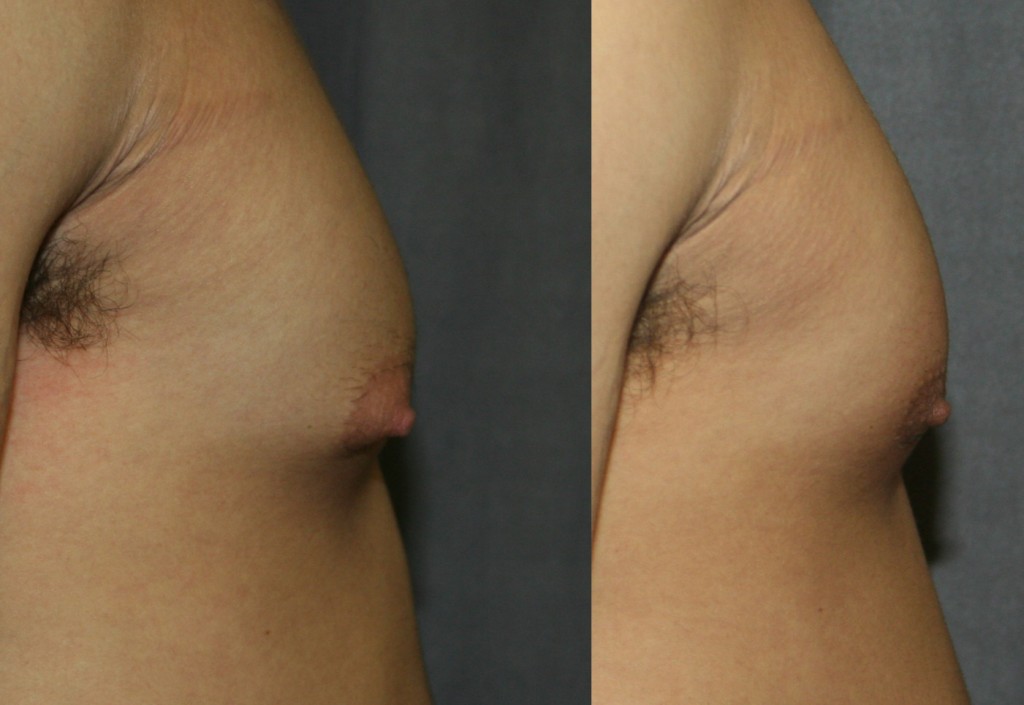 Gynecomastia isolated to the area beneath the nipple can cause puffy nipples. Gynecomastia Reduction Surgery can provide a smooth, more masculine profile.