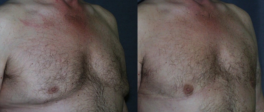 This patient had prior gynecomastia reduction, with improvement in the size of the chest; however, he was left with indented nipples from over resection, and the excess skin was never addressed. By replacing tissue beneath the nipples, and removing the excess skin, a more aesthetic result is obtained.