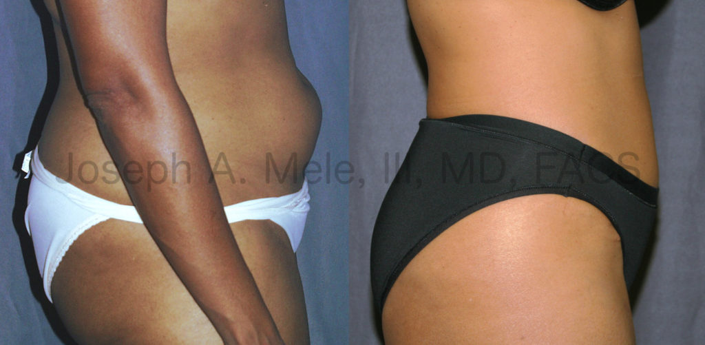 Liposuction removes disproportionate fat. In the above before and after pictures, Liposculpture is used to further enhance a Tummy Tuck.