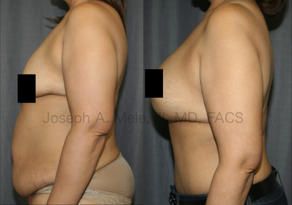 Breast Augmentation with Breast Lift (Mastopexy Augmentation) and Tummy Tuck. Breast Enlargement when the breasts are sagging and the nipples are below the inframammary fold requires a Breast Lift to achieve an aesthetic result. The Tummy Tuck further enhances the breasts' proportion by flattening the belly.