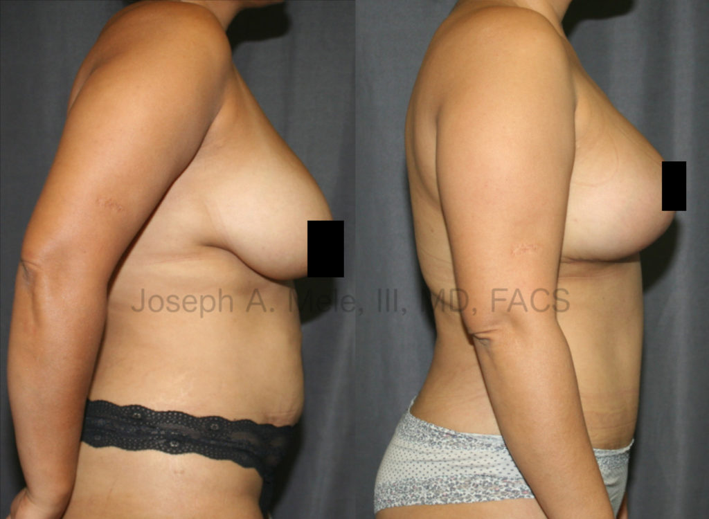 Breast Augmentation Lift – When the breasts are close to the desired size, sometimes a Breast Lift alone is all that is needed to create youthful, perky breasts. If the upper pole is empty, a small implant can be used to  enhance the shape of the breasts by adding fullness to the bust line without over exaggerating the size.