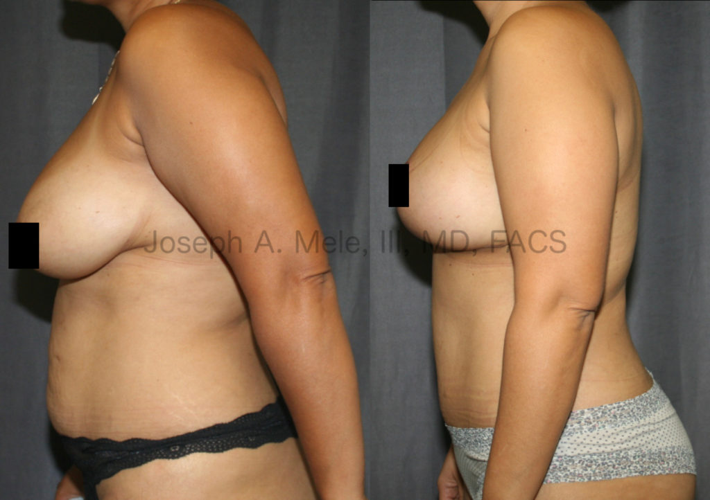 Mommy Makeovers include breast and belly enhancement in one surgery.