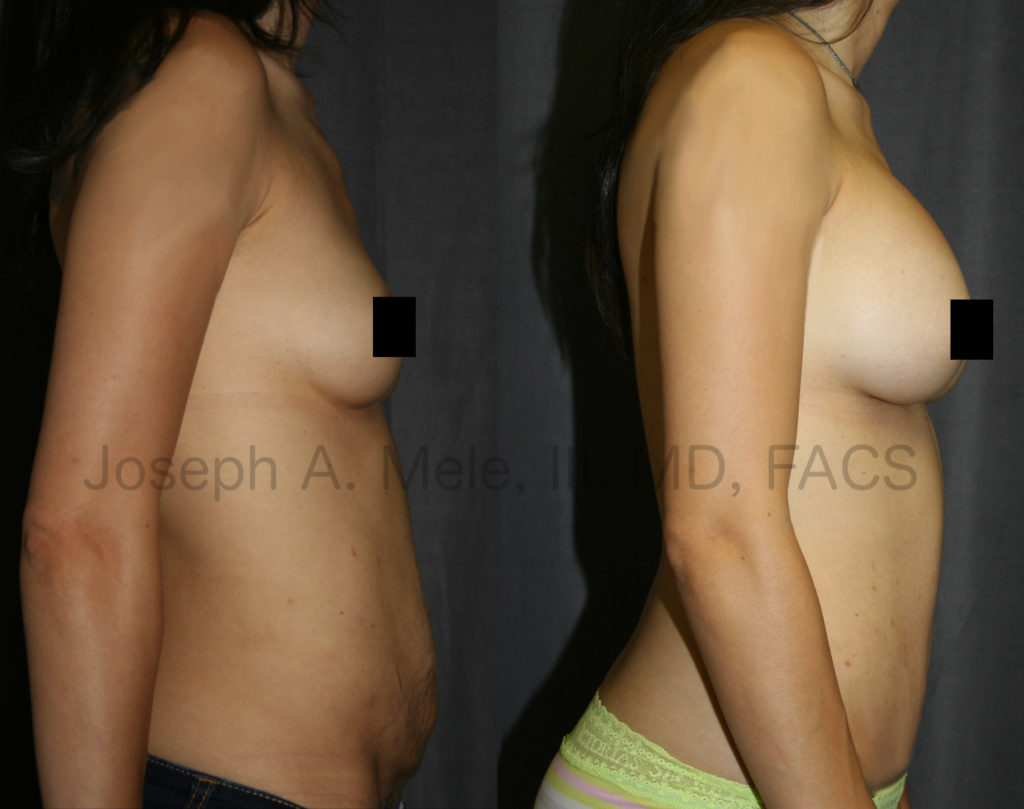 This Mommy Makeover included Breast Augmentation and a Tummy Tuck, the most common combination for restoring the body after childbirth.