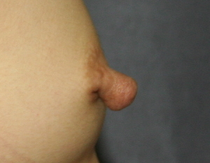 Close-up of breast showing appearance of nipple enlargement after pregnancy.