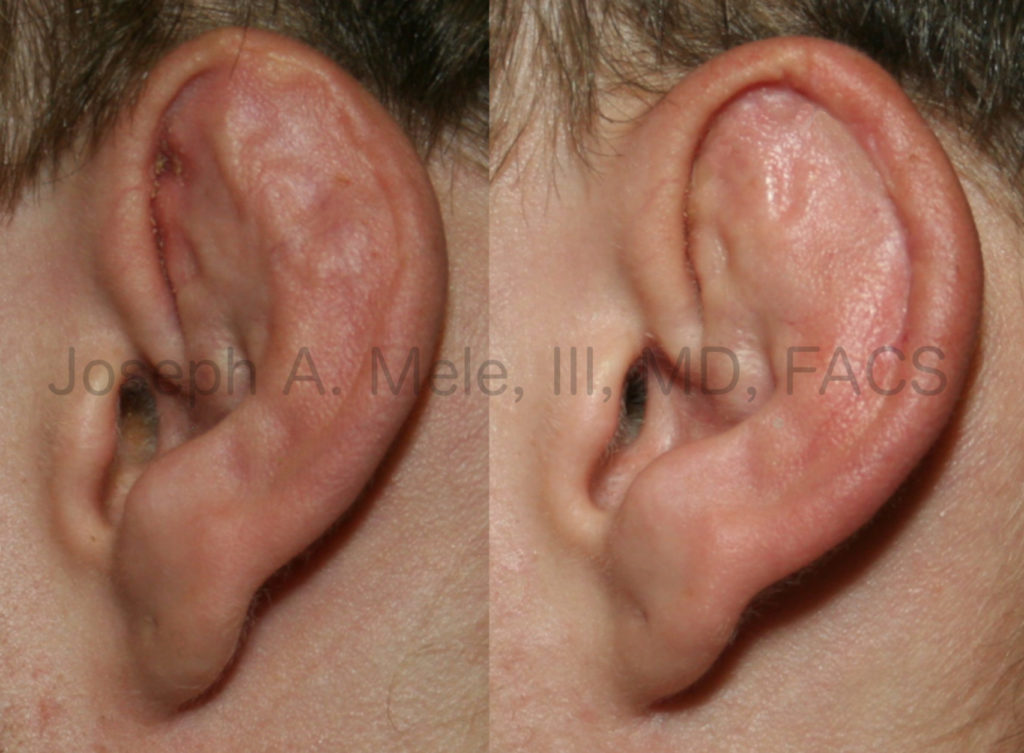 This cauliflower ear is thick. This ear has the typical appearance of a cauliflower ear. It is thick and irregular. The hematoma has filled the ear up to the rim of the helix and solidified. Plastic surgery was performed to remove the dense scar tissue, and restore the normal topography of the external ear.