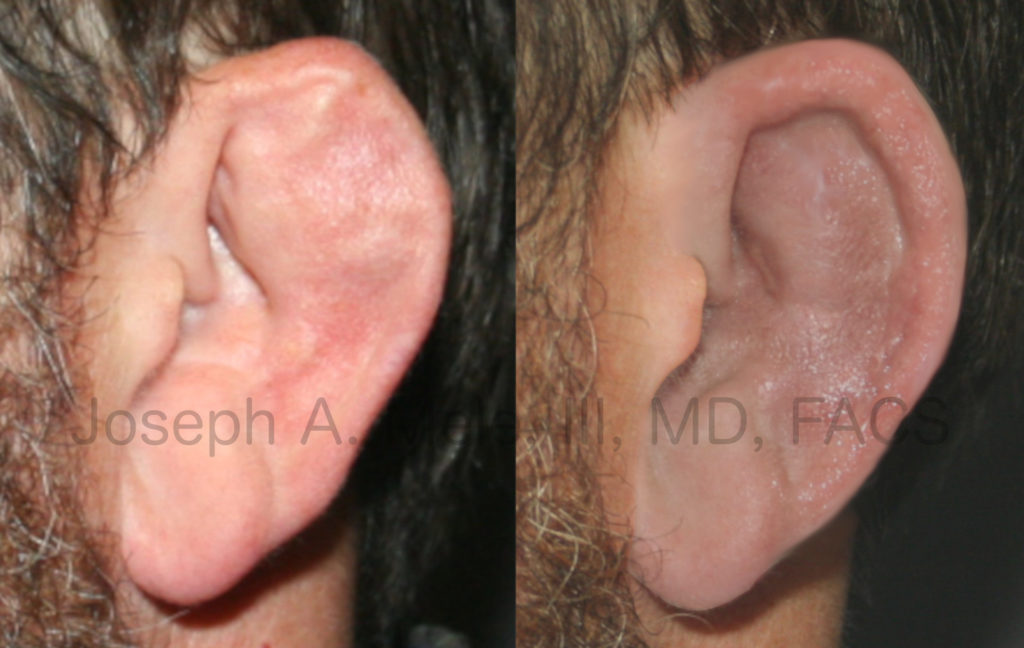 Cauliflower ear is caused by trauma. Like most medical problems, prevention or early intervention are preferable. Late treatment, as shown in the Cauliflower Ear Before and After Pictured above, can help; however, creating a beautiful ear is very difficult.