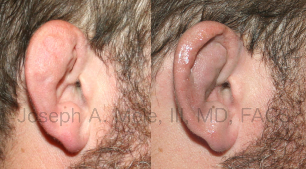 Cauliflower ear is caused by trauma. Like most medical problems, prevention or early intervention are preferable. Late treatment, as shown in the Cauliflower Ear Before and After Pictured above, can help; however, creating an aesthetically pleasing ear after this type of trauma is very challenging.