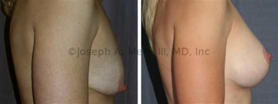 Breast Augmentation Mastopexy