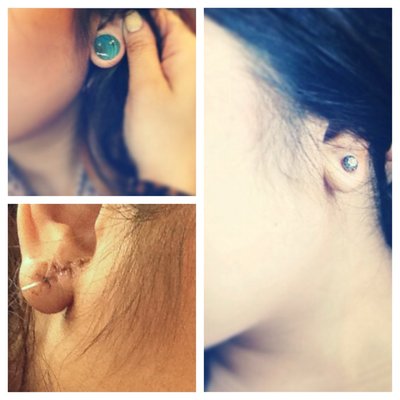 Earlobe Repair was performed to close a large hole caused by Ear Scapelling. The gauge was removed, the opening closed and later repierced. Thanks to RR for posting her photos and nice review on Yelp.