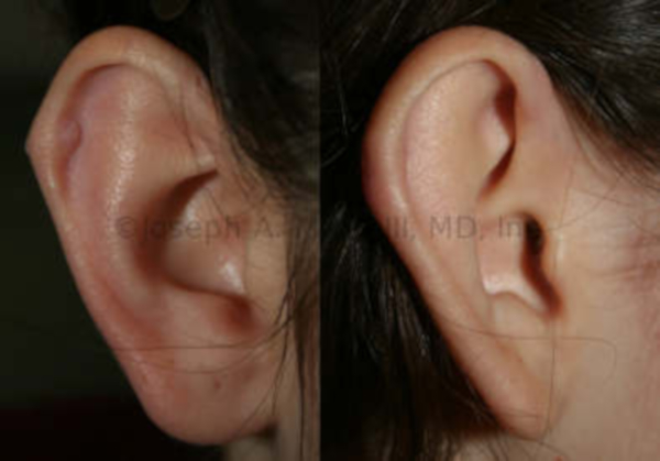 Ear repair after ear piercing gone bad - before and after pictures