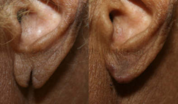 Plastic Surgery for torn earlobes - before and after pictures