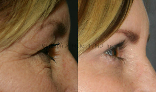 The Eyelid Lift or Blepharoplasty removes the skin that hangs over the eyes and the bags that hang under the eyes.