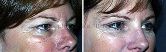 Blepharoplasty (Eyelid Lift) Before and Afters: In our 40's we start to notice facial aging. Though body procedures are still the most popular, the eyelids begin getting some extra attention.