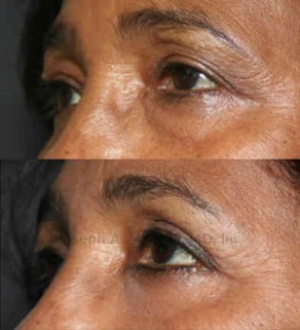After blepharoplasty, the upper eyelid crease is singular and  more defined, while the lower eyelid bags have been removed.
