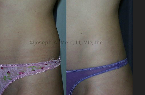 Out of tight low-rise jeans this muffin top may seem subtle, but <strong>Liposuction</strong> makes her curves even more shapely.