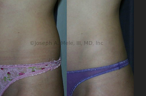 Liposuction of the Muffin Top Waistline Deformity - Explore Plastic Surgery