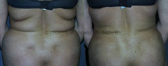 Liposuction removes excess fat from the bra-line, lower back and upper buttocks, and another Muffin Top is reduced.