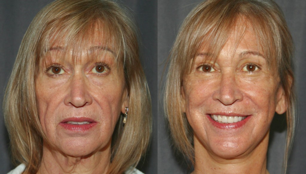 Facelifts can reverse signs of aging and remove lines associated with worry, fatigue and even anger.